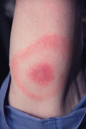 Bull’s-eye rash on a human arm
