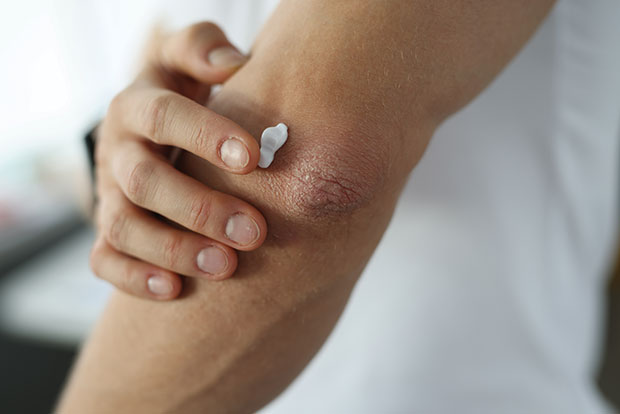 Man applying topical cream to damaged skin of elbow